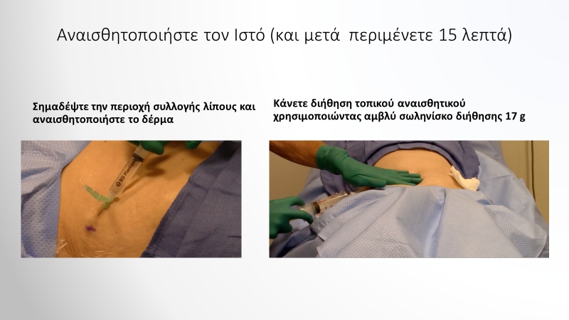 Αναισθητοποιήστε τον Ιστό (και μετά περιμένετε 15 λεπτά)
